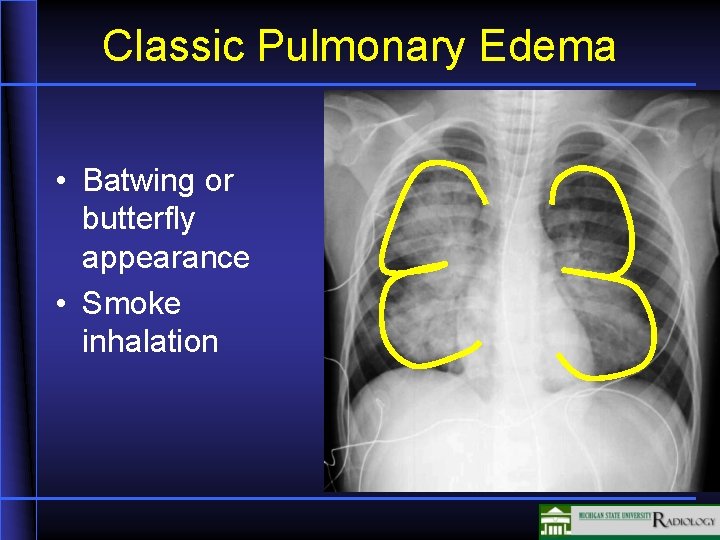 Classic Pulmonary Edema • Batwing or butterfly appearance • Smoke inhalation 