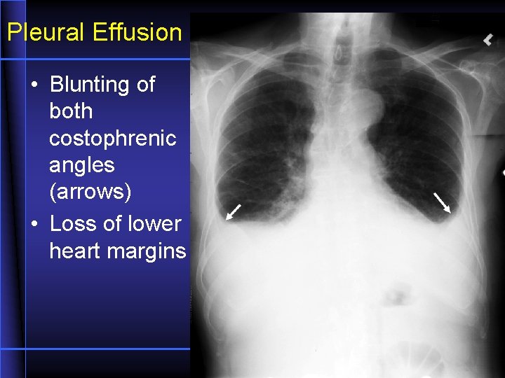 Pleural Effusion • Blunting of both costophrenic angles (arrows) • Loss of lower heart