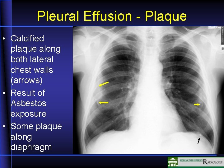 Pleural Effusion - Plaque • Calcified plaque along both lateral chest walls (arrows) •