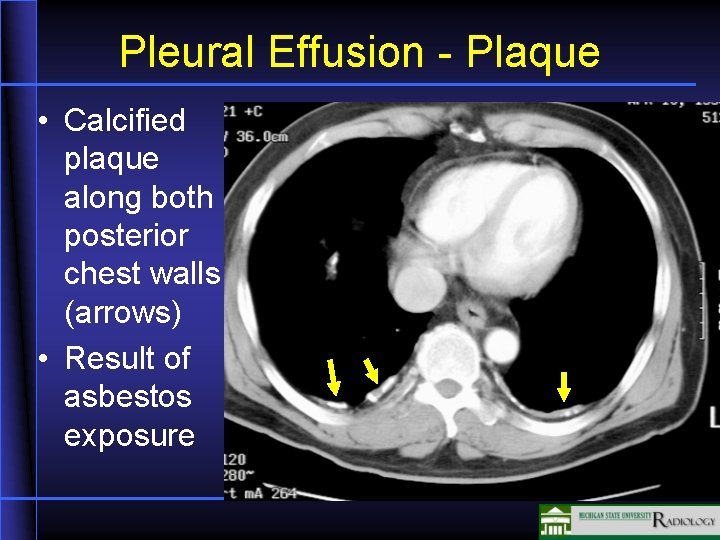 Pleural Effusion - Plaque • Calcified plaque along both posterior chest walls (arrows) •