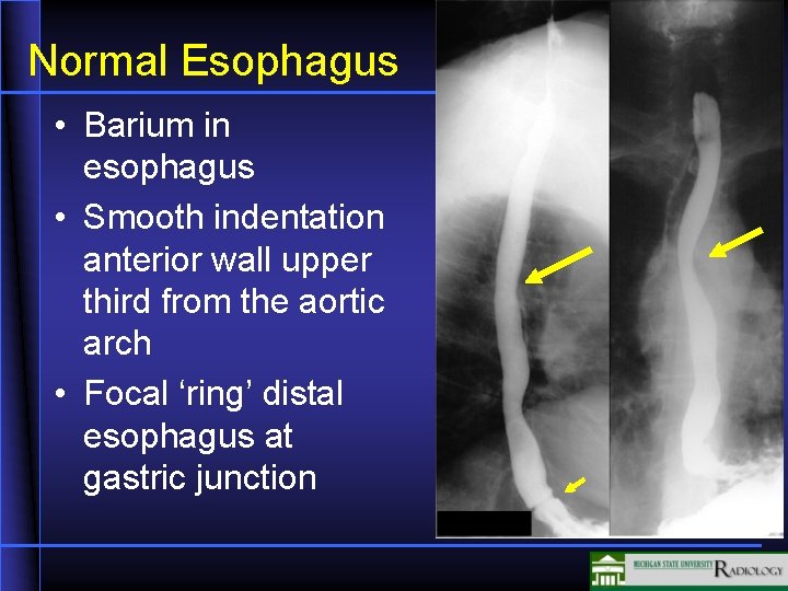 Normal Esophagus • Barium in esophagus • Smooth indentation anterior wall upper third from