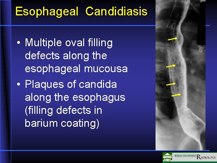 Esophageal Candidiasis • Multiple oval filling defects along the esophageal mucousa • Plaques of Esophageal Candidiasis • Multiple oval filling defects along the esophageal mucousa • Plaques of