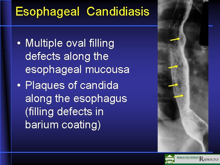 Esophageal Candidiasis • Multiple oval filling defects along the esophageal mucousa • Plaques of