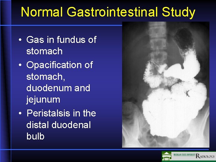 Normal Gastrointestinal Study • Gas in fundus of stomach • Opacification of stomach, duodenum