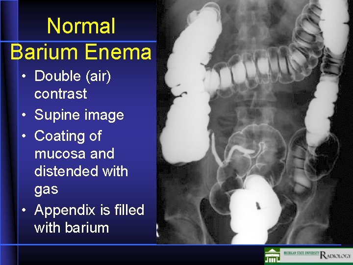 Normal Barium Enema • Double (air) contrast • Supine image • Coating of mucosa