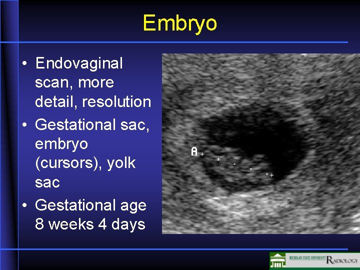 Embryo • Endovaginal scan, more detail, resolution • Gestational sac, embryo (cursors), yolk sac