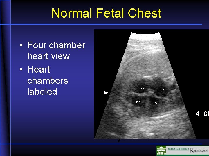 Normal Fetal Chest • Four chamber heart view • Heart chambers labeled RA RV