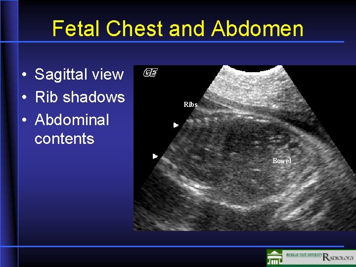 Fetal Chest and Abdomen • Sagittal view • Rib shadows • Abdominal contents Ribs