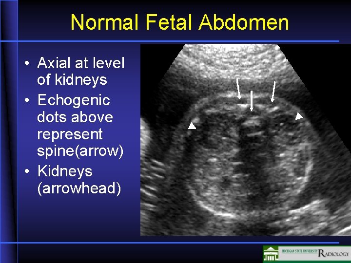 Normal Fetal Abdomen • Axial at level of kidneys • Echogenic dots above represent