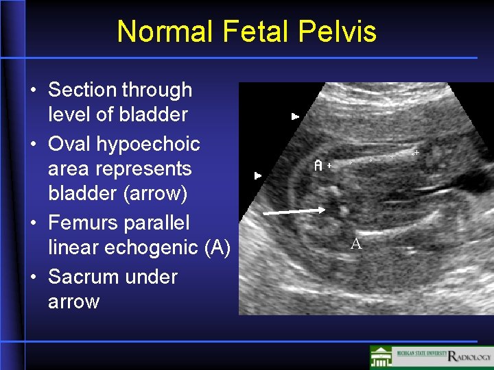 Normal Fetal Pelvis • Section through level of bladder • Oval hypoechoic area represents