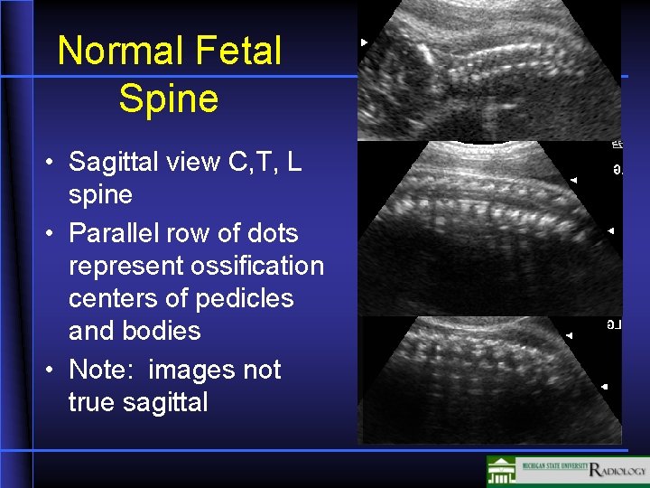 Normal Fetal Spine • Sagittal view C, T, L spine • Parallel row of