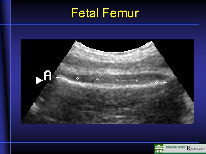 Fetal Femur 