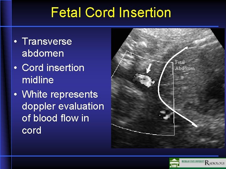 Fetal Cord Insertion • Transverse abdomen • Cord insertion midline • White represents doppler