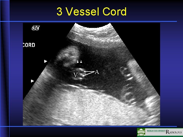 3 Vessel Cord V A 