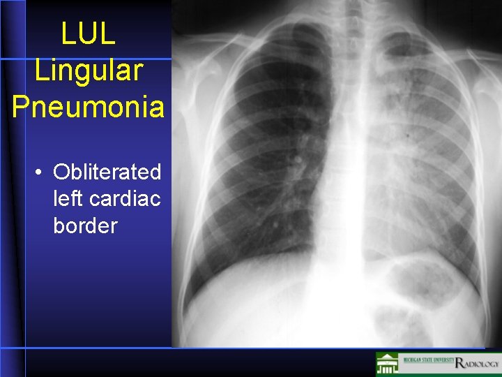 LUL Lingular Pneumonia • Obliterated left cardiac border 