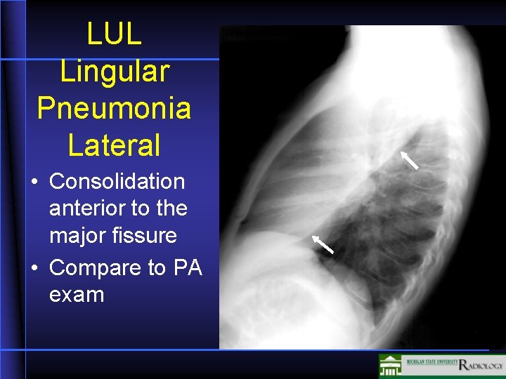 LUL Lingular Pneumonia Lateral • Consolidation anterior to the major fissure • Compare to