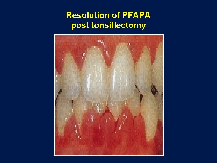 Resolution of PFAPA post tonsillectomy 