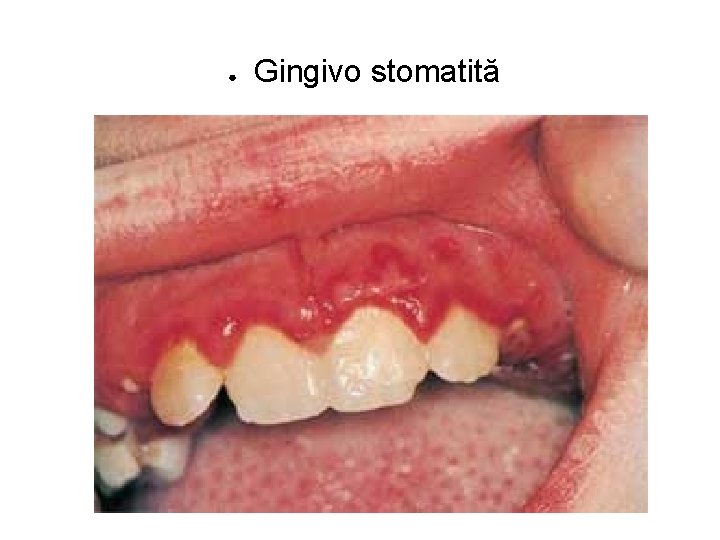 ● Gingivo stomatită 