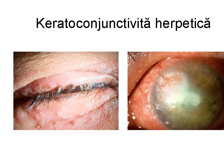 Keratoconjunctivită herpetică 