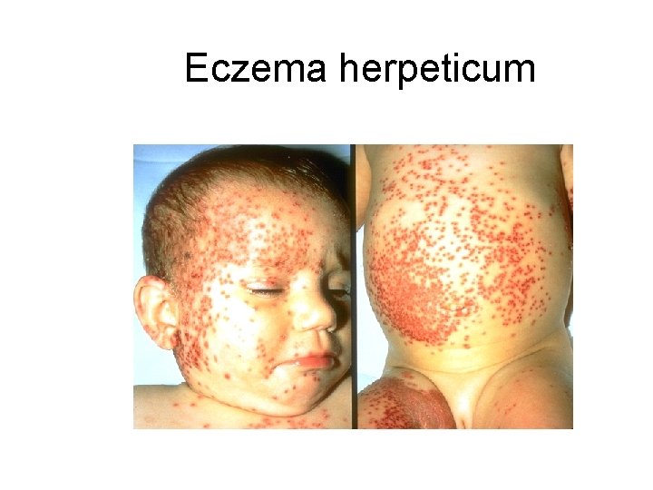 Eczema herpeticum 