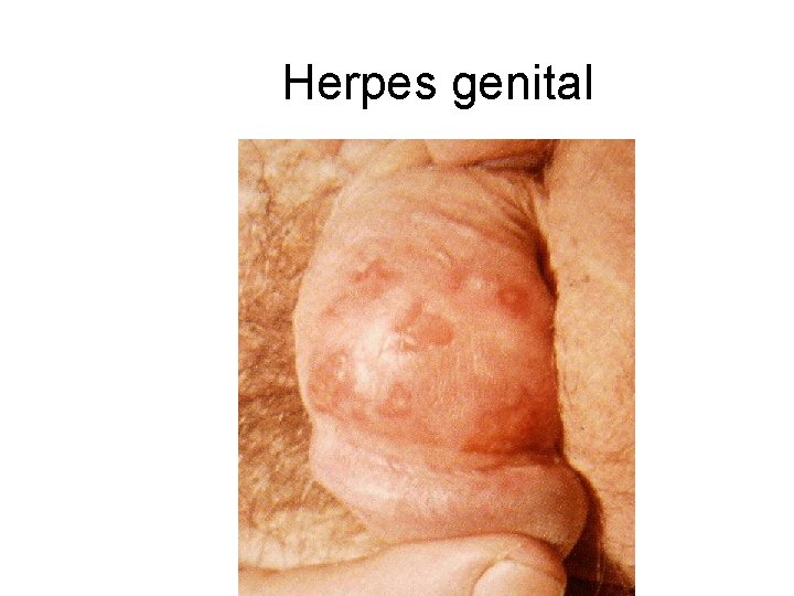 Herpes genital 