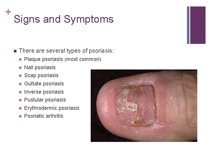 psoriasis symptoms and signs