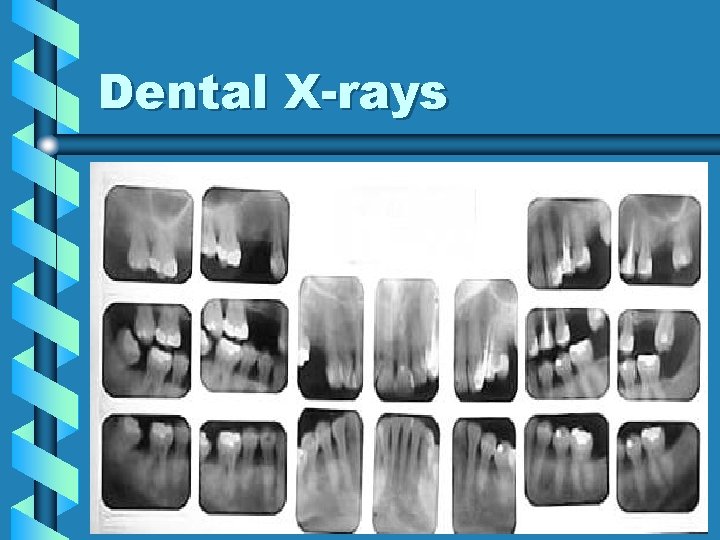 Dental X-rays 