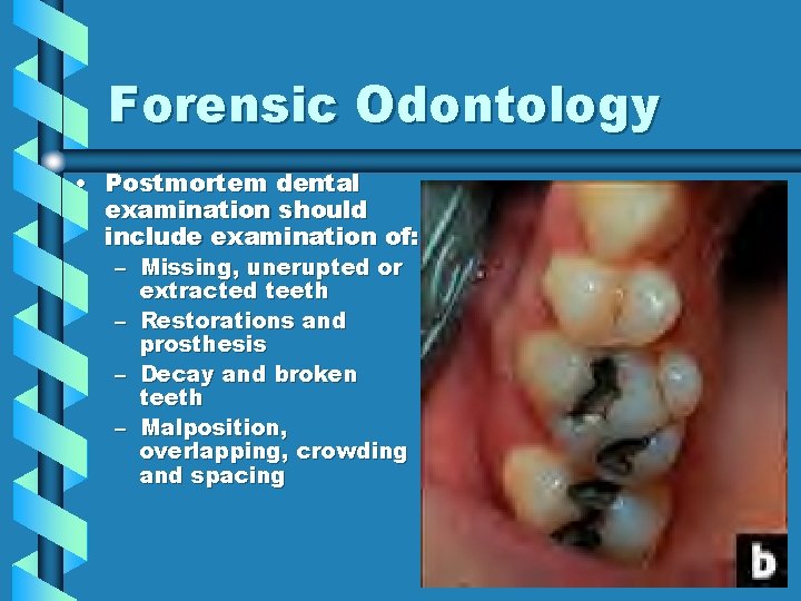 Forensic Odontology • Postmortem dental examination should include examination of: – Missing, unerupted or