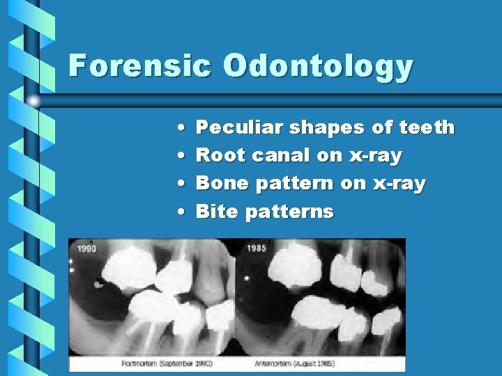 Forensic Odontology • • Peculiar shapes of teeth Root canal on x-ray Bone pattern