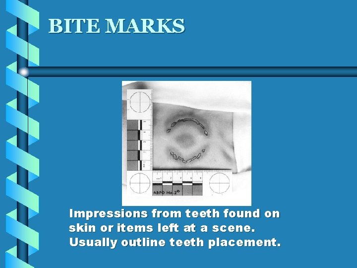 BITE MARKS Impressions from teeth found on skin or items left at a scene.