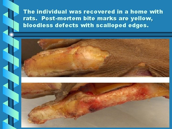 The individual was recovered in a home with rats. Post-mortem bite marks are yellow,