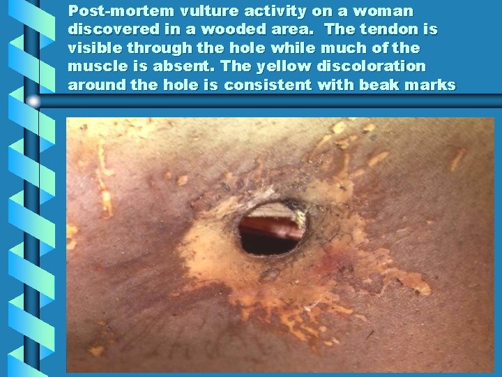 Post-mortem vulture activity on a woman discovered in a wooded area. The tendon is