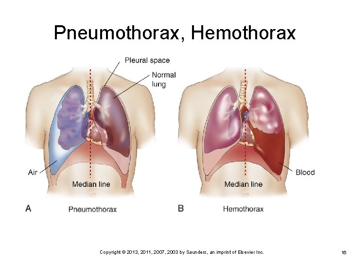 Pneumothorax, Hemothorax Copyright © 2013, 2011, 2007, 2003 by Saunders, an imprint of Elsevier