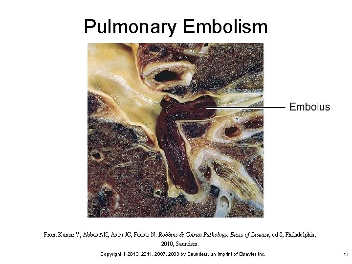 Pulmonary Embolism From Kumar V, Abbas AK, Aster JC, Fausto N: Robbins & Cotran