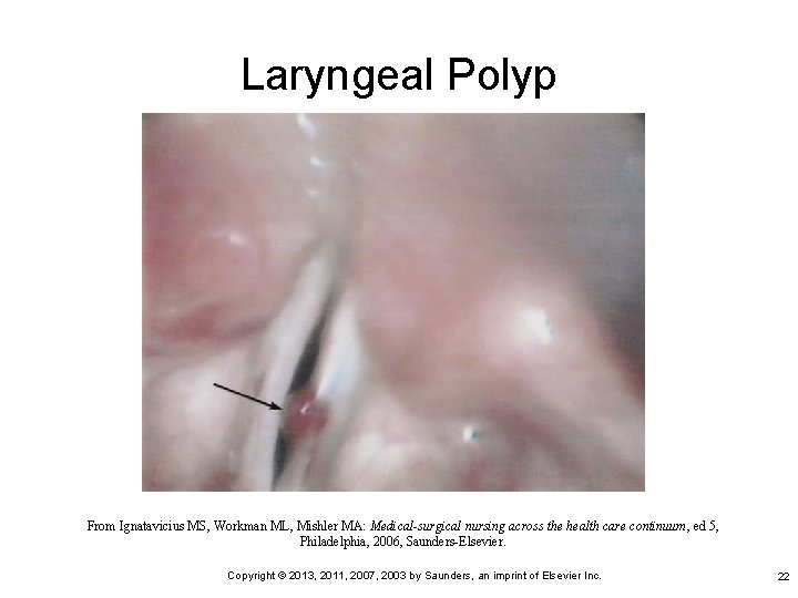 Laryngeal Polyp From Ignatavicius MS, Workman ML, Mishler MA: Medical-surgical nursing across the health