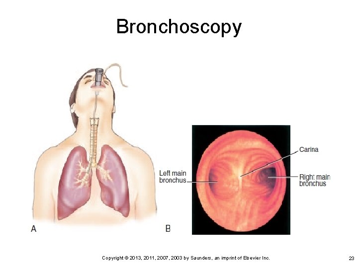 Bronchoscopy Copyright © 2013, 2011, 2007, 2003 by Saunders, an imprint of Elsevier Inc.