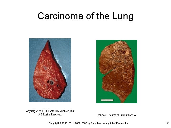 Carcinoma of the Lung Copyright © 2011 Photo Researchers, Inc. All Rights Reserved. Courtesy
