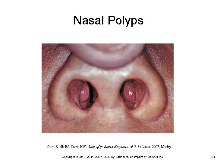 Nasal Polyps from Zitelli BJ, Davis HW: Atlas of pediatric diagnosis, ed 5, St