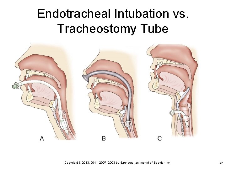 Endotracheal Intubation vs. Tracheostomy Tube Copyright © 2013, 2011, 2007, 2003 by Saunders, an