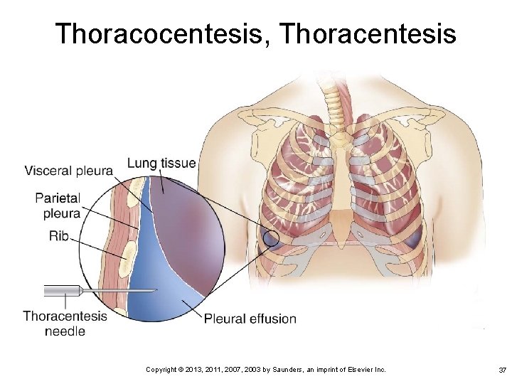 Thoracocentesis, Thoracentesis Copyright © 2013, 2011, 2007, 2003 by Saunders, an imprint of Elsevier