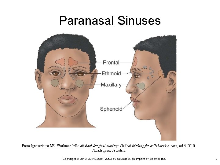 Paranasal Sinuses From Ignatavicius MS, Workman ML: Medical-Surgical nursing: Critical thinking for collaborative care,