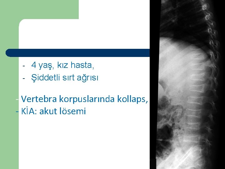 Vaka 1 - 4 yaş, kız hasta, Şiddetli sırt ağrısı - Vertebra korpuslarında kollaps,