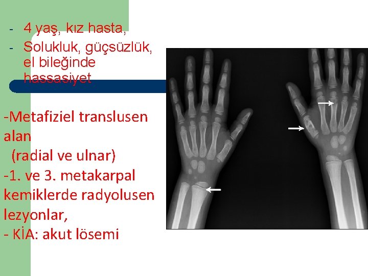 - 4 yaş, kız hasta, Solukluk, güçsüzlük, el bileğinde hassasiyet -Metafiziel translusen alan (radial