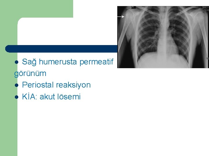 Vaka 3 Sağ humerusta permeatif görünüm l Periostal reaksiyon l KİA: akut lösemi l Vaka 3 Sağ humerusta permeatif görünüm l Periostal reaksiyon l KİA: akut lösemi l