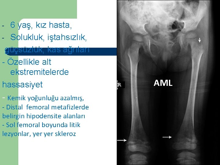 6 yaş, kız hasta, Vaka - Solukluk, iştahsızlık, güçsüzlük, kas ağrıları - Özellikle alt