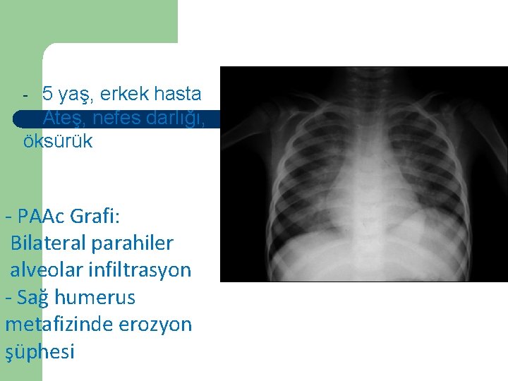 Vaka 5 5 yaş, erkek hasta - Ateş, nefes darlığı, öksürük - - PAAc