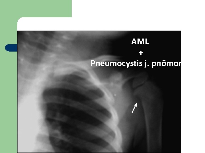 Vaka 5 AML + Pneumocystis j. pnömonisi Vaka 5 AML + Pneumocystis j. pnömonisi
