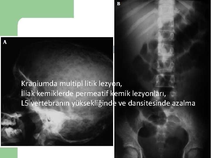 Vaka 9 Kraniumda multipl litik lezyon, İliak kemiklerde permeatif kemik lezyonları, L 5 vertebranın