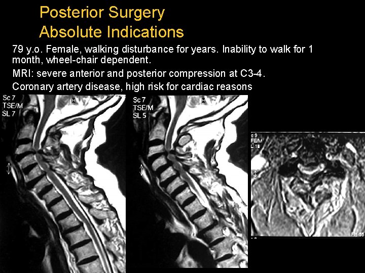 Posterior Surgery Absolute Indications 79 y. o. Female, walking disturbance for years. Inability to