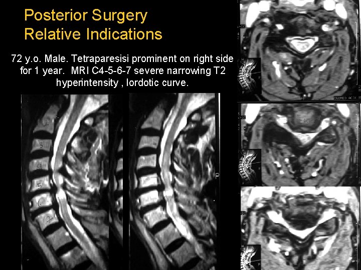 Posterior Surgery Relative Indications 72 y. o. Male. Tetraparesisi prominent on right side for